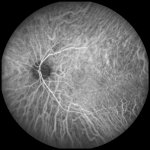 Indocyanine Green Angiography(ICGA)
