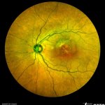 Fundus Fluorescein Angiography FFA: Retinal circulatory change